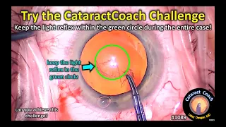 CataractCoach 1089: take the CataractCoach challenge - can you do it?