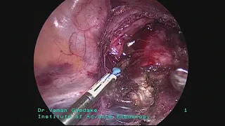 isthmocele repair  and difficult bladder dissection voice