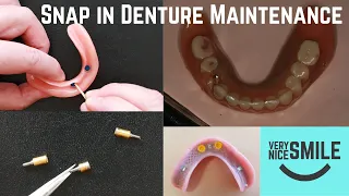 What goes wrong with snap in dentures.