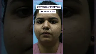 Acne scar treatment | Dermaroller for acne scars | #acnescars #shorts #youtubeshort #acne #skincare