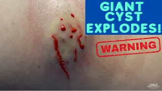 Watch This Giant Cyst SQUIRT! 😲