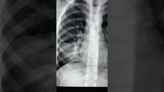 Round opacity in a child X ray - Classic case