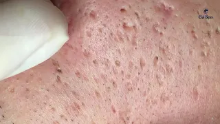 BLACKHEAD ACNES. Just Touch the Skin, So Many Acne Bounce Off...