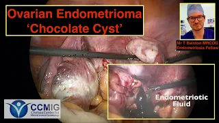 Endometrioma Chocolate Cyst! Laparoscopy and drainage of Endometrioma Step by Step.