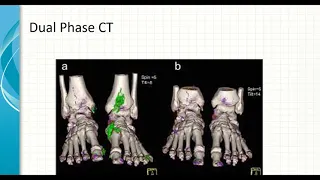 Understanding Gout and Other Forms of Microcrystalline Inflammatory Arthritis