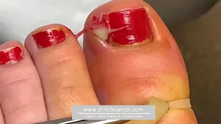 Draining pus from an ingrown toenail