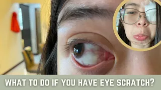 First Aid for Corneal Abrasion (Eye Scratch) | Do's and Dont's | Doc Chabi Channel