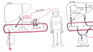 Diabetes Type II Pathophysiology