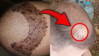 Hair Transplant without Finasteride! 3 Years later. I review My Subscriber's Hair Transplant.