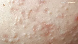 Hidden acne Extraction on young girl at hien van spa-431-Ngoc Thuy