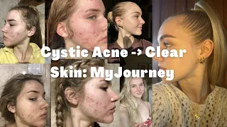 CYSTIC ACNE TO CLEAR SKIN: MY JOURNEY