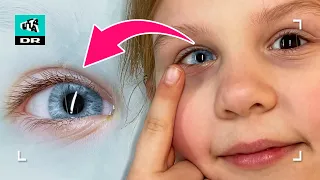 Har sjælden øjensygdom! Får Sophia farve i øjnene?