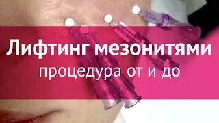 Подтяжка лица мезонитями: процедура от и до