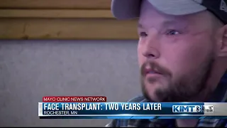 Two years later: Face transplant progress