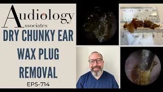 DRY CHUNKY EAR WAX PLUG REMOVAL - EP714