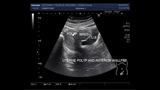 Uterine Polyp with Fibroid on Ultrasound.