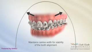 Damon Arch Form - Braces