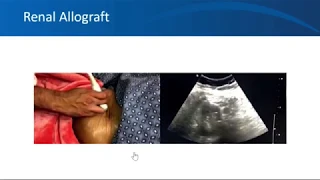 Renal ultrasound video 2, University of Florida Nephrology, by Dr. Koratala (Twitter: @NephroP)