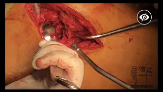 Cirugía prótesis de cadera