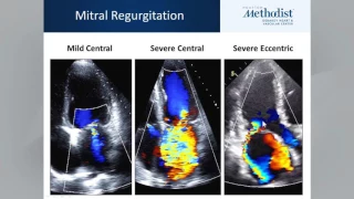 ASE Guidelines for Native Valvular Regurgitation Webinar