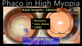 Phaco in Highly Myopic Eye- Challenges & Priorities - Dr Deepak Megur