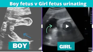 Baby girl vs baby boy captured urinating inside womb on Ultrasound!