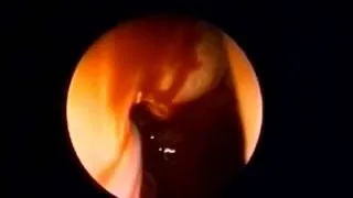 Endoscopic Revision DCR