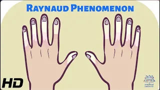 Blue Fingers and Toes: Understanding Raynaud Phenomenon