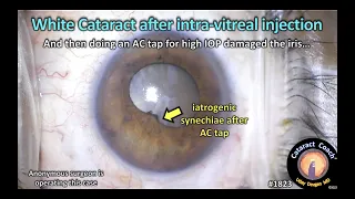 CataractCoach™1823: white cataract after intra-vitreal injection