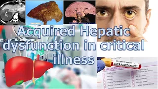 Acquired Hepatic dysfunction in critical illness #criticalcaremedicine #ediçãoaesthetic #mrcp #neet