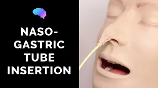 Nasogastric (NG) Tube Insertion - OSCE Guide