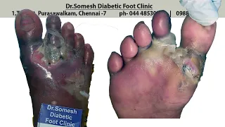 #GangreneToe spreading cellulitis healing stages