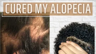 I cured my Alopecia Areata NATURALLY!! | No steroids! No hair implants!