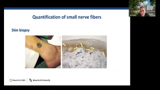 Translating Insights from Genetic Analyses in Painful Small Fiber Neuropathy into Pharmacological Pr