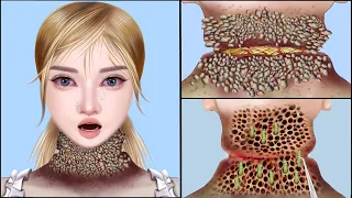 ASMR Animation Remove DogTick & Maggot Neck | Severely Injured Animation | Universe ASMR