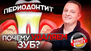 Когда нужно удалять зуб при периодонтите? Немецкий имплантологический центр