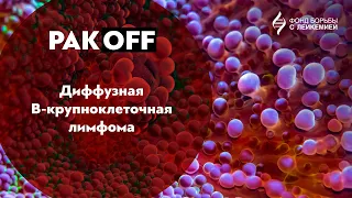 РакOFF: Диффузная В-крупноклеточная лимфома (ДВКЛ)