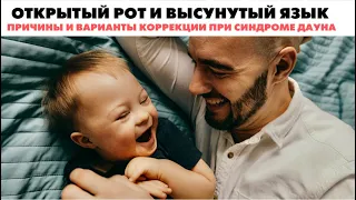 ПРО ВЫСУНУТЫЙ ЯЗЫК И ОТКРЫТЫЙ РОТ У ДЕТЕЙ С СИНДРОМОМ ДАУНА: ПРИЧИНЫ И РЕКОМЕНДАЦИИ КОРРЕКЦИИ.