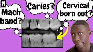 Caries Vs Cervical burnout Vs Mach band effect | Interpretation of Dental Caries