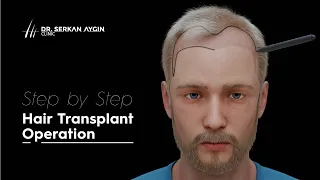 Step by Step Hair Transplant Operation
