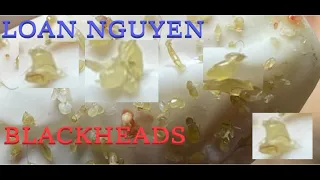 Blackheads extraction and whiteheads (198) | Loan Nguyen