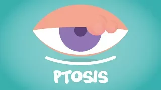 What is Ptosis?