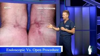Carpal Tunnel Release - Open Procedure vs. Endoscopic