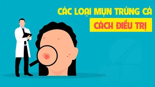 Các loại mụn trứng cá và cách điều trị