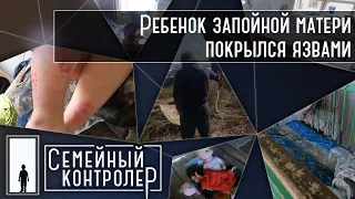 Ребенок запойной матери покрылся язвами | Семейный контролер