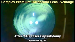 Intraocular lens exchange - remove synergy & place Panoptix - after YAG capsulotomy. Unhappy synergy