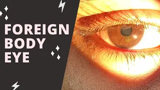 Foreign Body Eye || Case Discussion