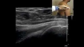 How I Do It: Shoulder US Anatomy, Technique, and Scanning Pitfalls (Radiology 260:1 July 2011)
