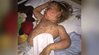 Parents call for national vaccination programme for chickenpox