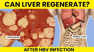 Can Liver Regenerate After HBV Infection | How to Regenerate Liver Damage  | Hepatitis B